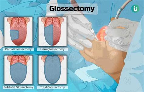 partial glossectomy with neck dissection.